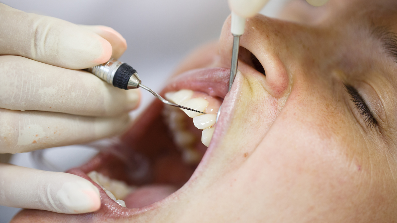Periodontal probe, held by dental hygienist, measuring pocket depths around tooth, examining progression of periodontal disease.