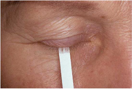 The Schirmer test is one of the ocular tests performed on patients suspected to have SjD, and is used to assess aqueous deficiency or dryness of the eye.