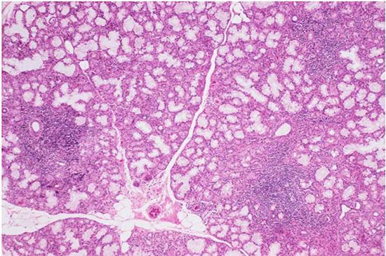Hematoxylin and eosin–stained labial salivary glands exhibiting focal lymphocytic sialadenitis, a pattern of inflammation that is commonly found in patients with SjD. Labial salivary glands are among the valuable specimens banked in the SICCA biorepository, and enabling new studies advancing SjD research.