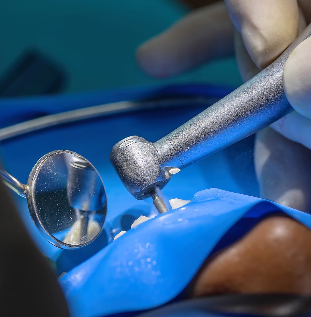 Close-up of a dentist using a high-speed drill and a dental mirror during a procedure on a patient's tooth.
